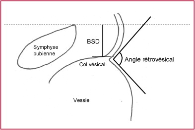 Imagen3 Incontinence Urinaire femme