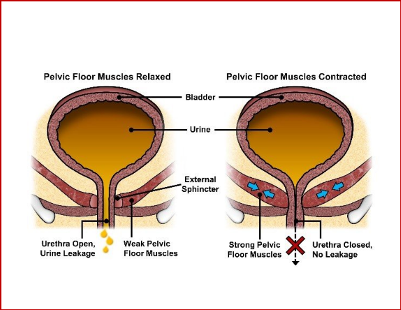 Imagen4 Incontinence Urinaire femme
